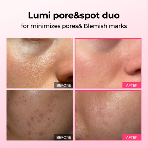 [TikTok Bestseller] Lumi Pore & Spot Care Duo